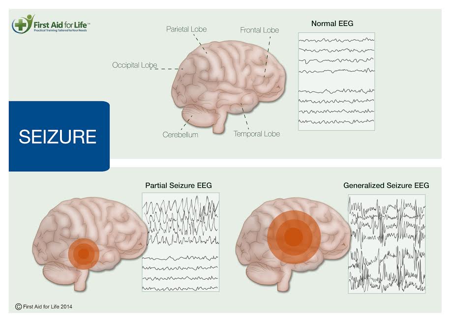 Brain waves in Seizure