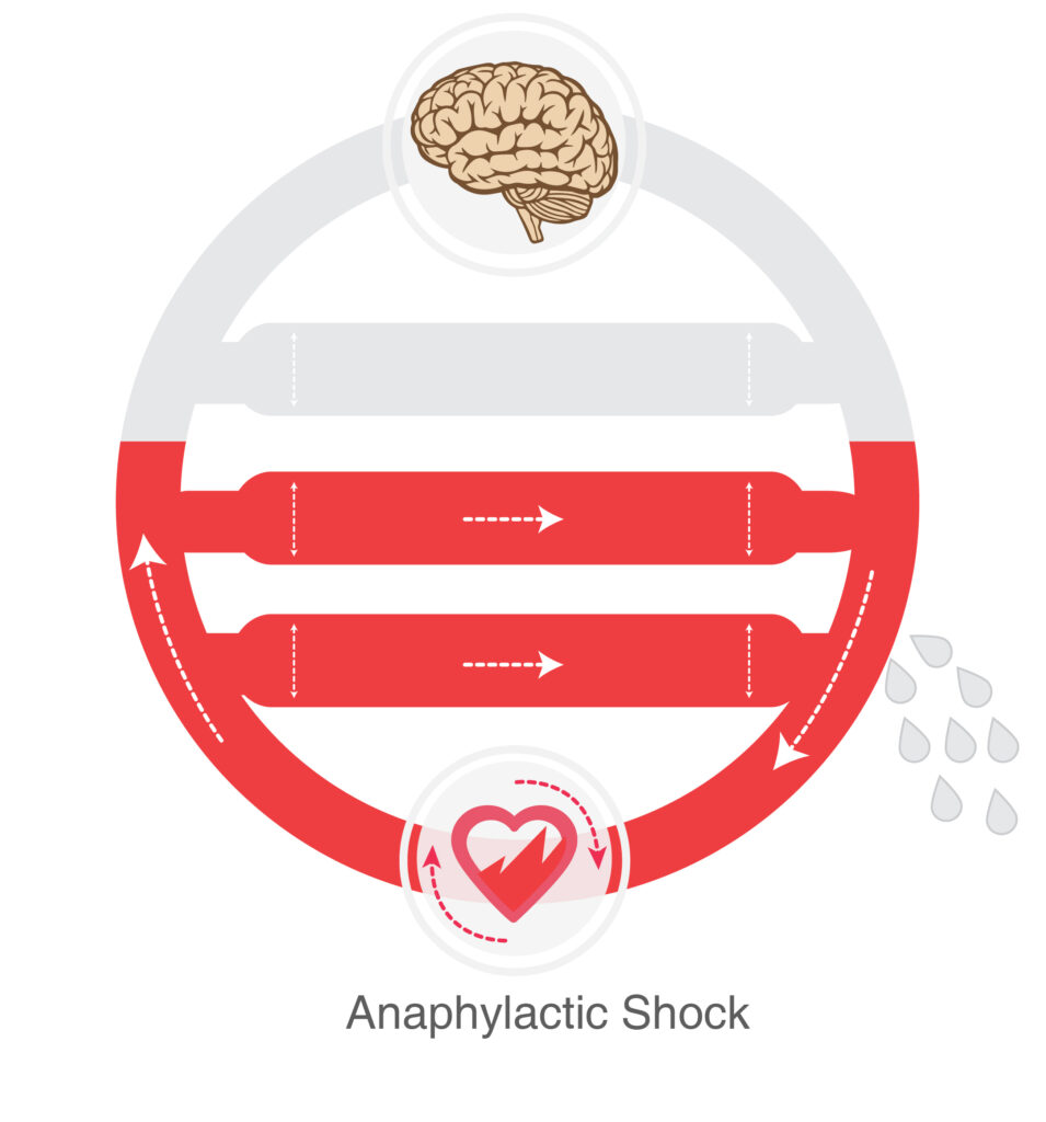 anaphylactic shock