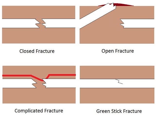 Types of fractures