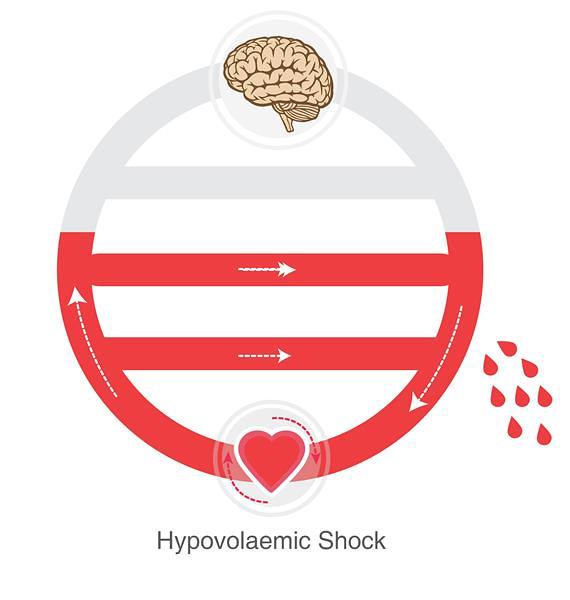 hypo shock